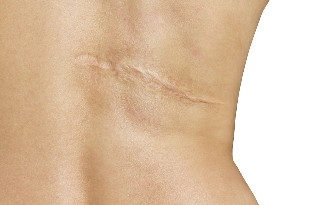 Wound Coverage